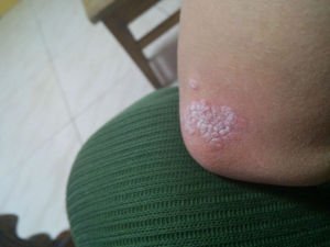 牛皮癣病因详解