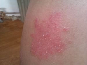 牛皮癣的发病机理有哪些呢?