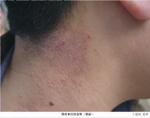 胡萝卜对牛皮癣有什么好处
