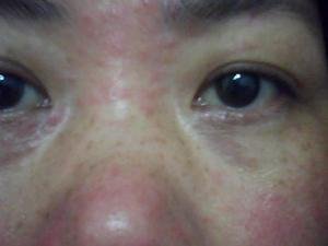 女性怀孕期间可以治疗牛皮癣吗
