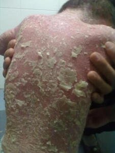 生活中治疗牛皮癣偏方有哪些