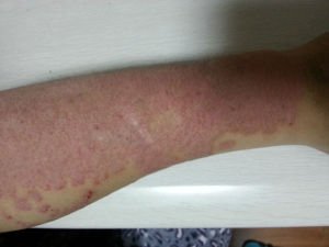 银屑病患者饮食要注意哪些?
