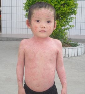 治疗牛皮癣的几种常见偏方