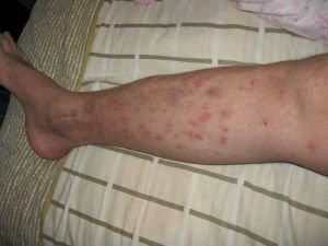 牛皮癣常识介绍?