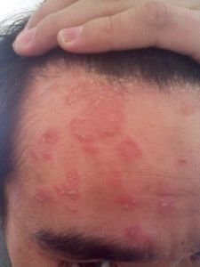 牛皮癣可以治好吗