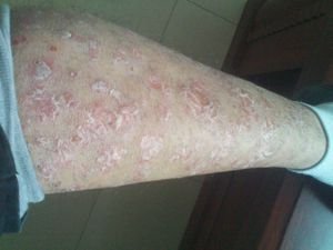 牛皮癣夏季养生需注意