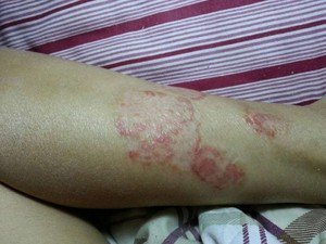 牛皮癣患者不可生吃鸡蛋
