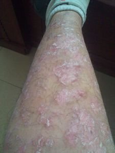 老年牛皮癣治疗困难吗