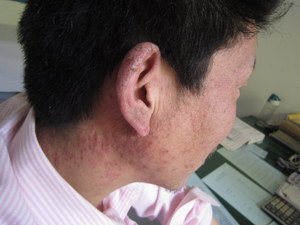 喝酒会引起牛皮癣吗?
