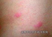 牛皮癣饮食
