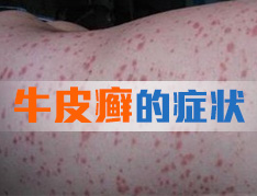 不同类型银屑病有哪些症状
